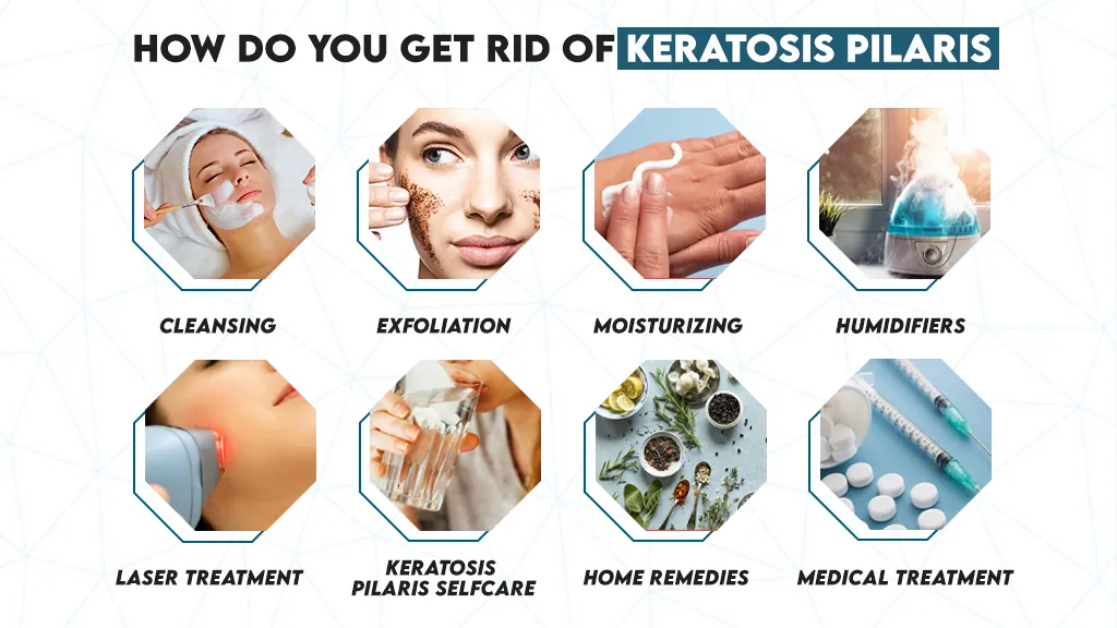 Keratosis Pilaris Treatment