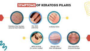 Symptoms of Keratosis Pilaris