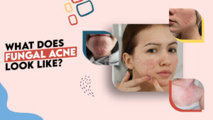 What Does Fungal Acne Look Like?