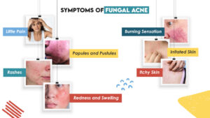 Symptoms of Fungal Acne