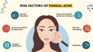 Risk Factors of Fungal Acne
