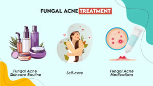 Fungal Acne Treatment 