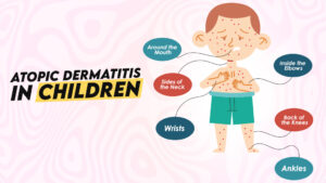 Atopic Dermatitis in Children
