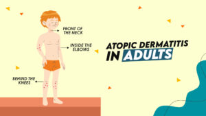 Atopic Dermatitis in Adults