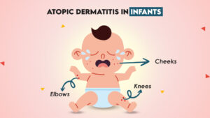 Infantile Atopic Dermatitis