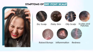 Symptoms of Dry Itchy Scalp