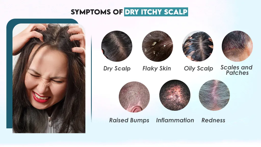 Symptoms of Dry Itchy Scalp