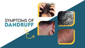 Symptoms of Dandruff