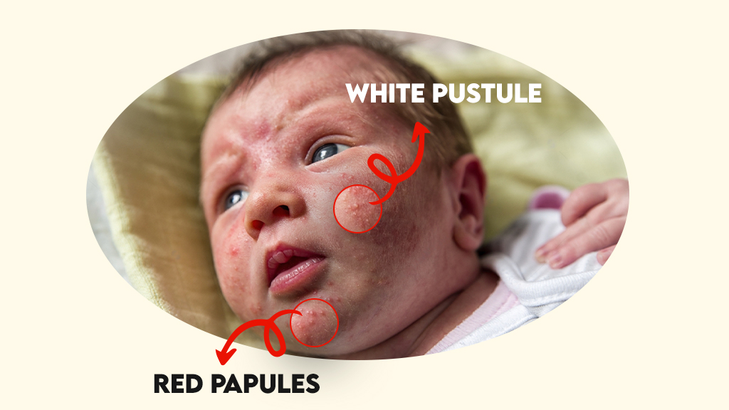 Red Papules Vs White Pustules