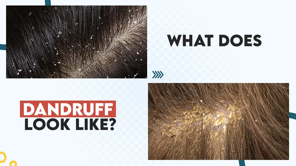 What Does Dandruff Look Like?