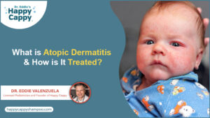 What is Atopic Dermatitis