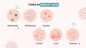 Understanding Breast Acne