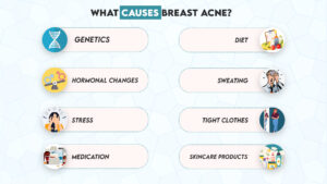 What Causes Breast Acne?