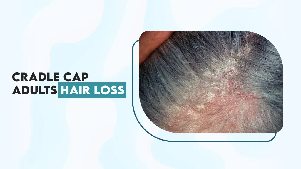 Cradle Cap Adults Hair Loss