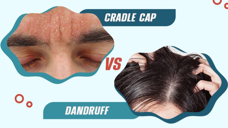Cradle Cap In Adults Treatment Symptoms Causes