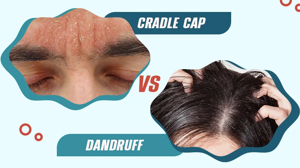 Cradle Cap VS Dandruff Cradle Cap VS Dandruff