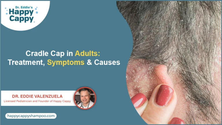 Cradle Cap in Adults: Treatment, Symptoms & Causes