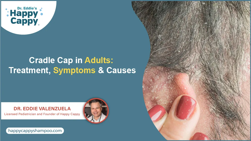 Cradle Cap in Adults Treatment, Symptoms & Causes