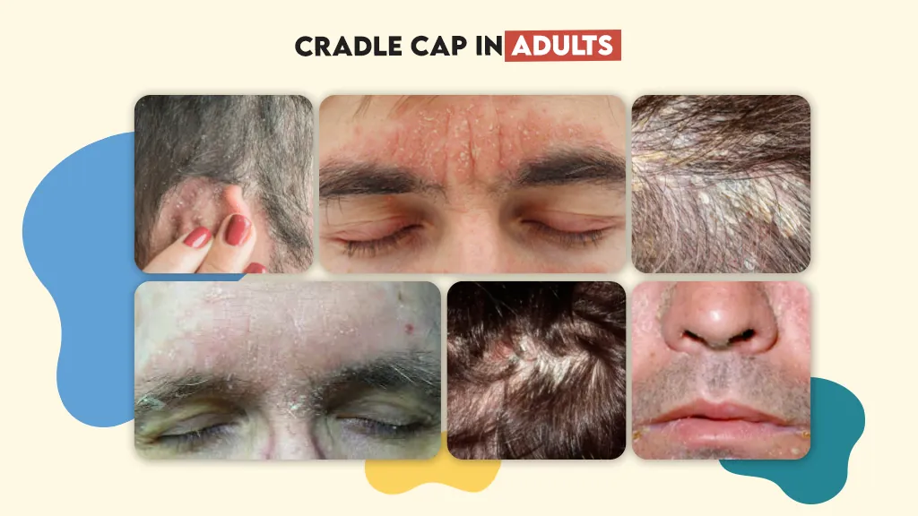 Pictures of Cradle Cap in Adults