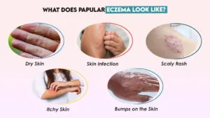 What Does Papular Eczema Look Like?