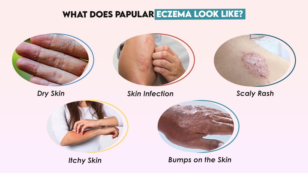 Papular Eczema: Symptoms and Treatment Options