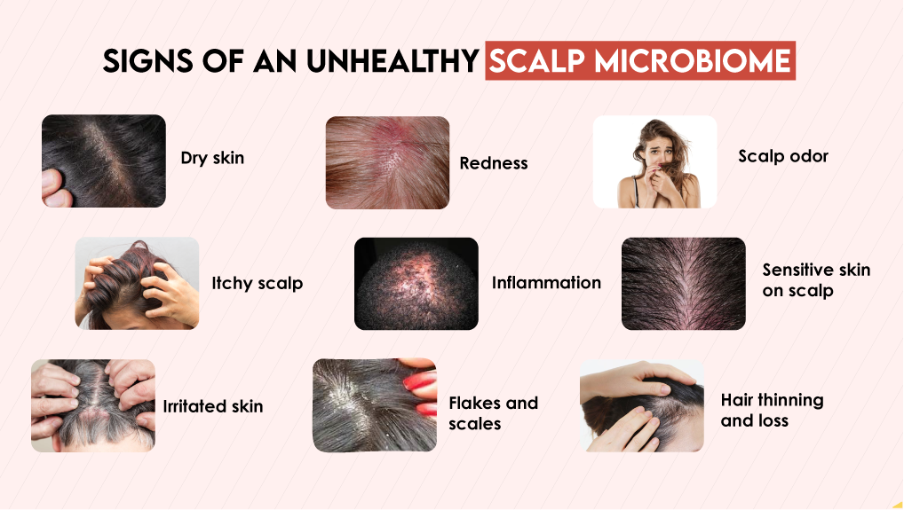 Signs of an Unhealthy Scalp Microbiome