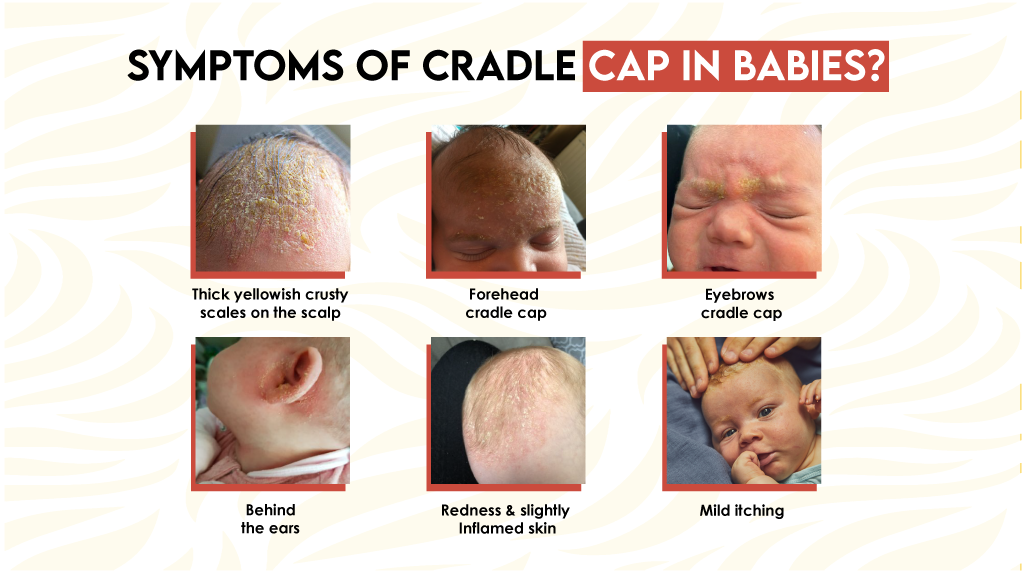 Symptoms of Cradle Cap In Babies?