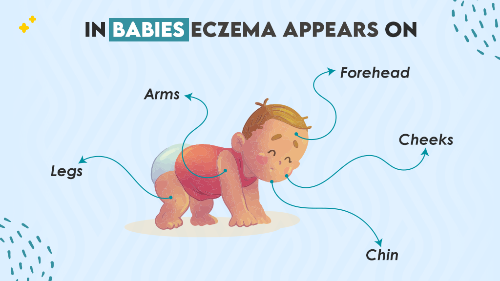 Do Babies Outgrow Eczema?