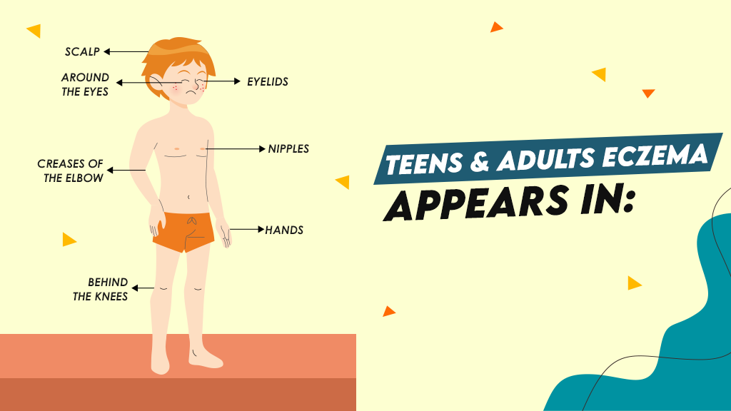 Teens & Adults Eczema Appears in