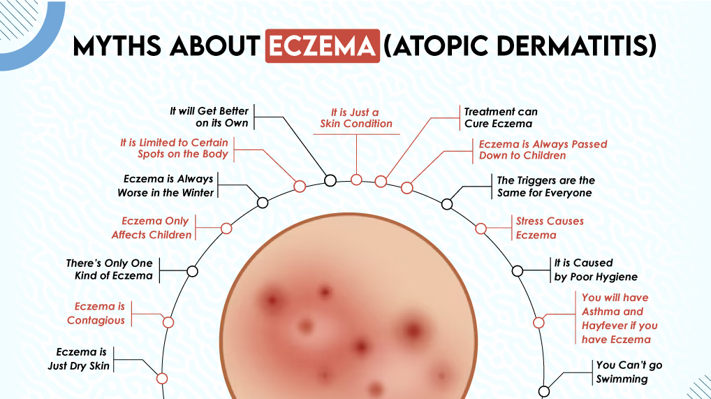 Myths About Eczema (Atopic Dermatitis)  