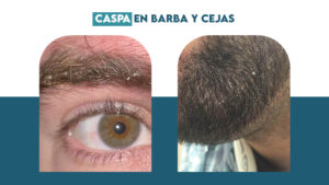 Caspa en Barba y Cejas