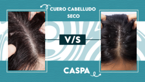 Caspa vs cuero cabelludo seco