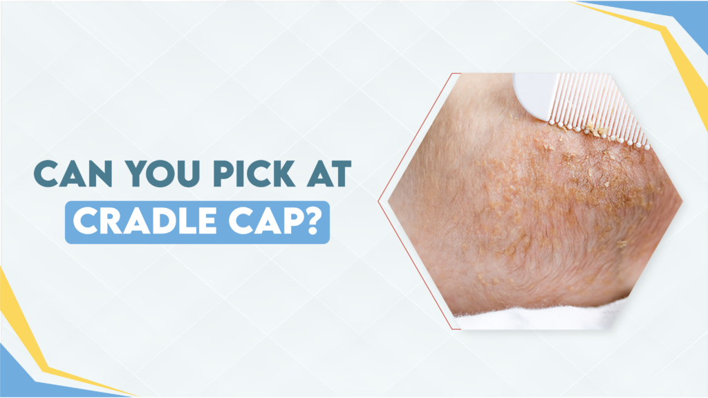 Can You Pick at Cradle Cap?