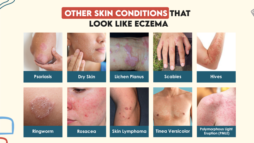 Other Skin Conditions That Look Like Eczema