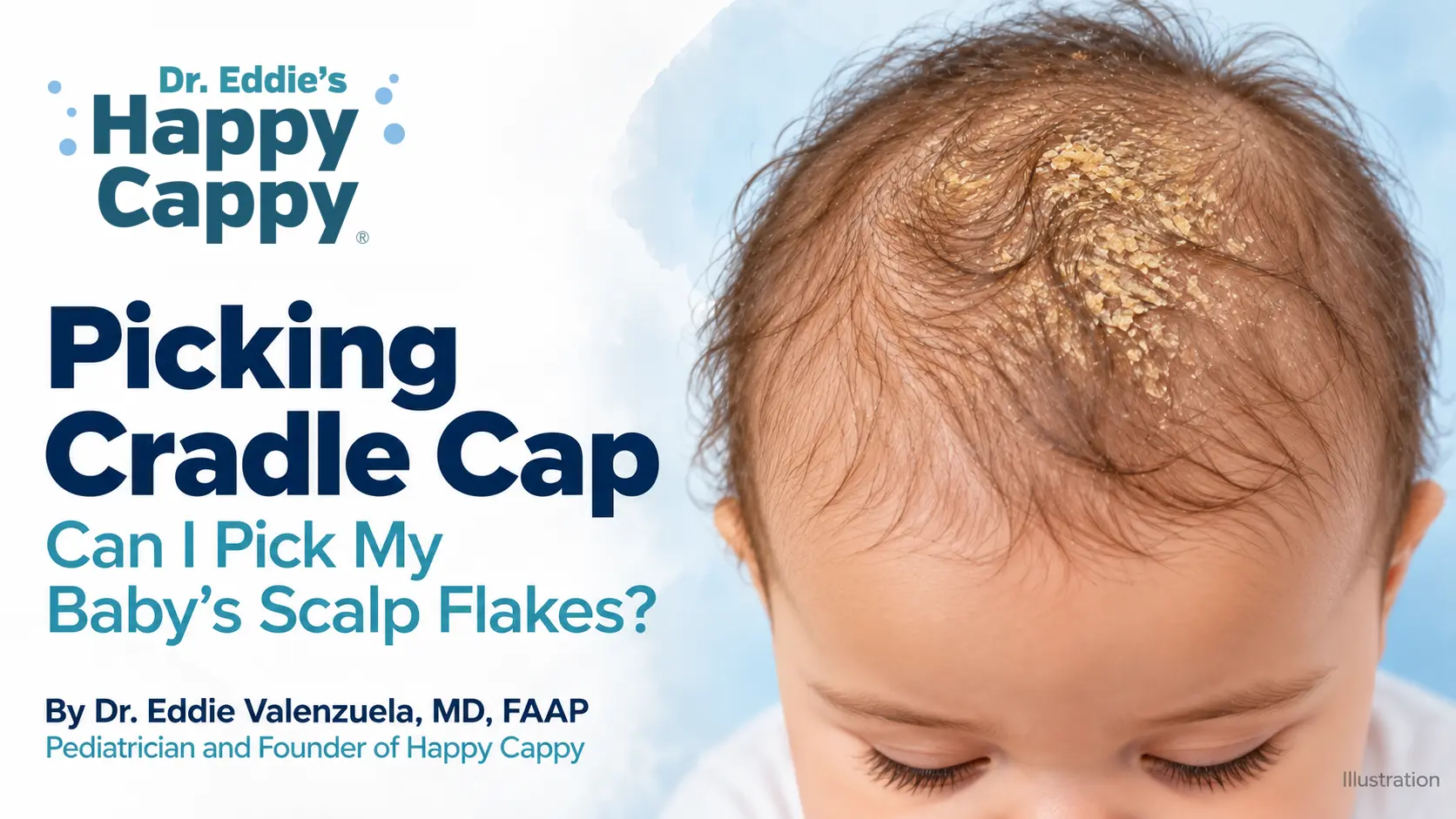 Picking Cradle Cap: Can I Pick My Baby’s Scalp Flakes?