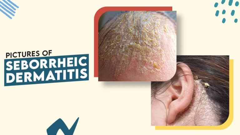 What is Seborrheic Dermatitis? Symptoms, Causes & Treatment