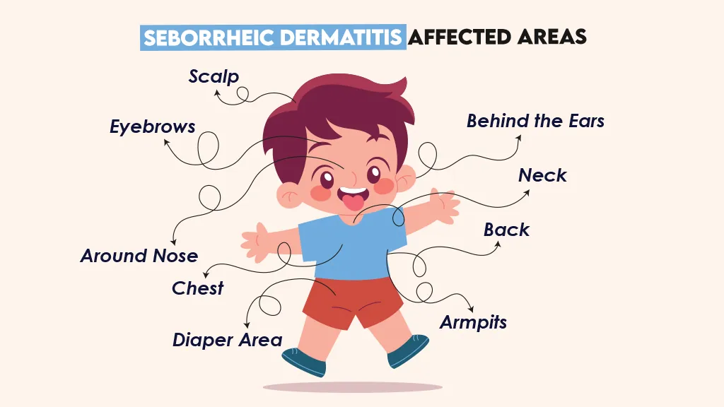 Seborrheic Dermatitis Affected Areas