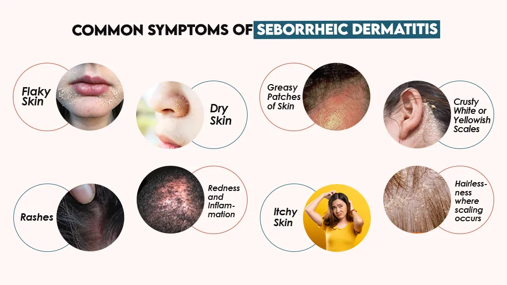 Common Symptoms of Seborrheic Dermatitis