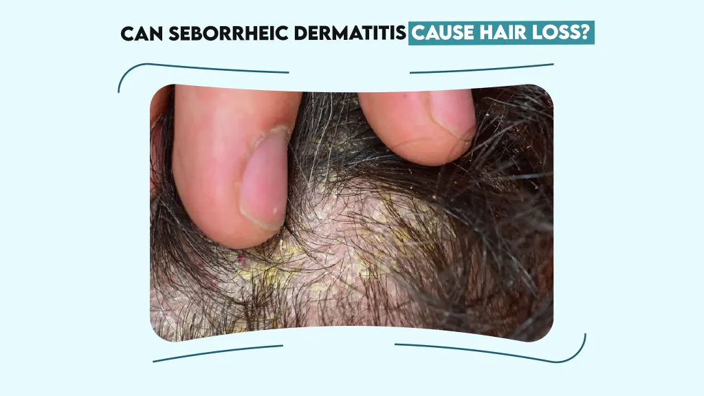 Can Seborrheic Dermatitis Cause Hair Loss?