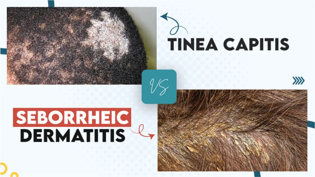 Tinea Capitis Vs Seborrheic Dermatitis