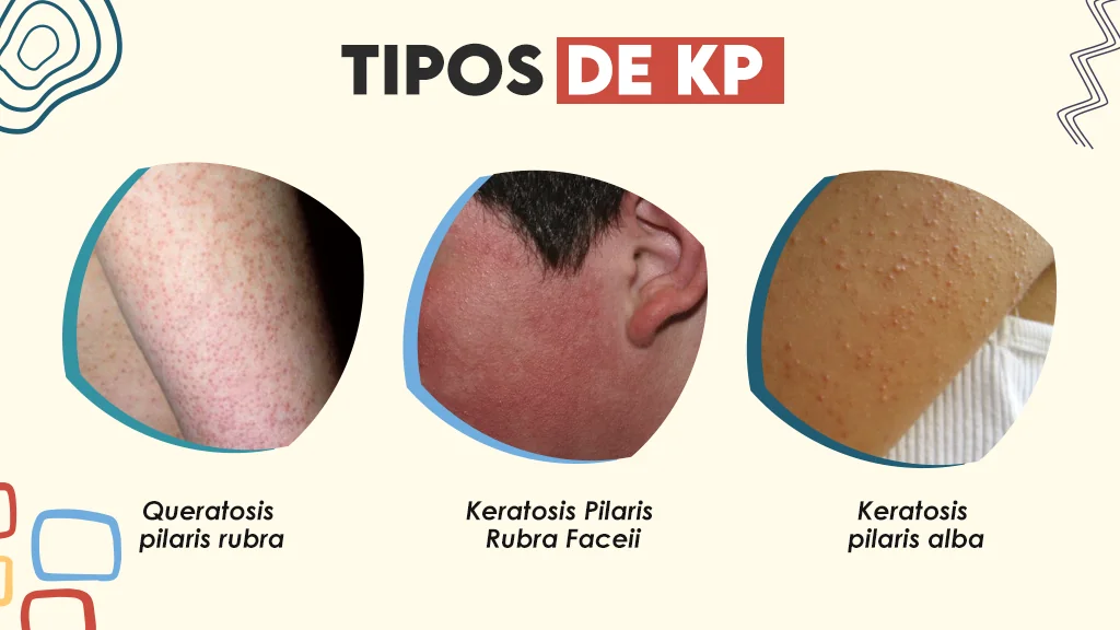 Tipos de KP