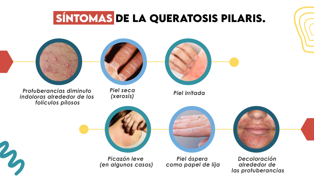 Síntomas de la queratosis pilaris