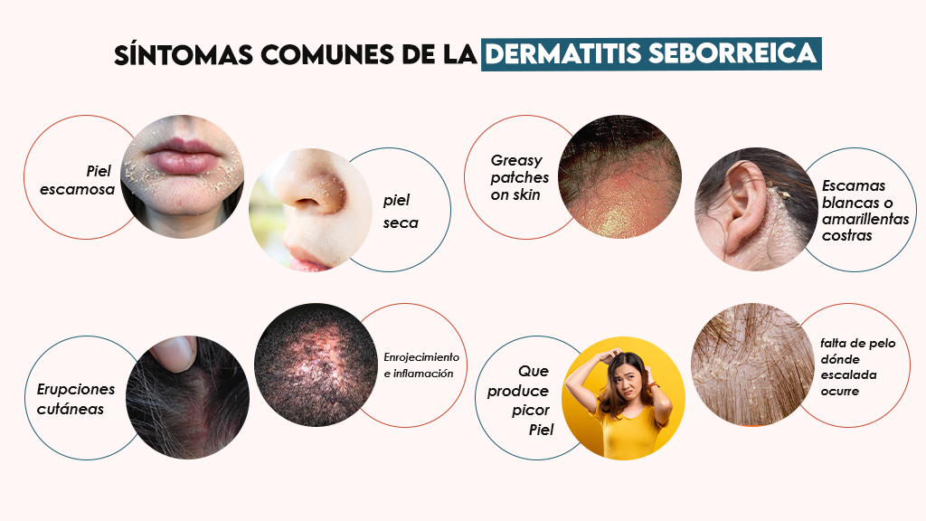 Síntomas comunes de la dermatitis seborreica