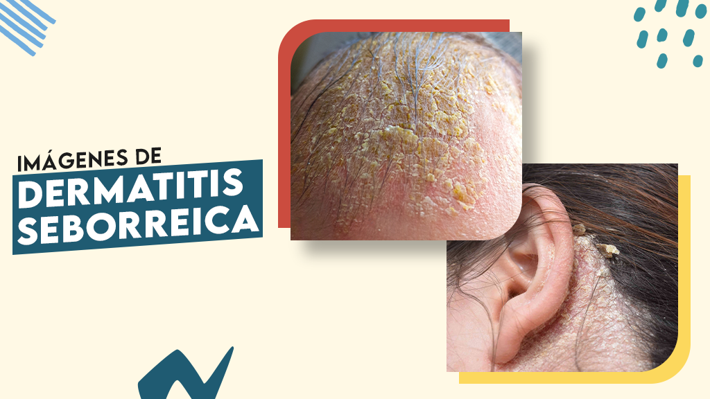 Imágenes de dermatitis seborreica