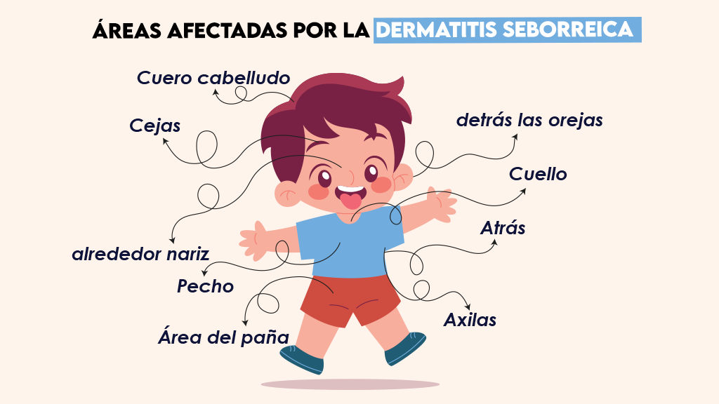 Áreas afectadas por la dermatitis seborreica