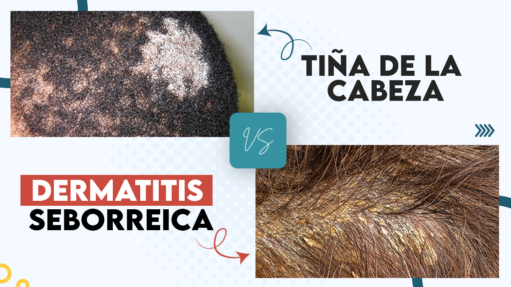 Tiña de la cabeza versus dermatitis seborreica