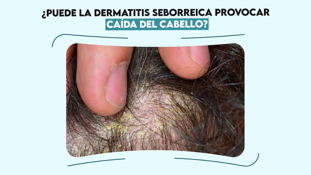 ¿Puede la dermatitis seborreica provocar caída del cabello?