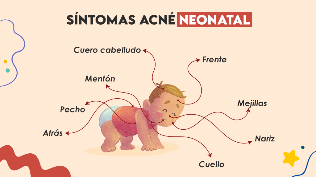 Síntomas acné neonatal