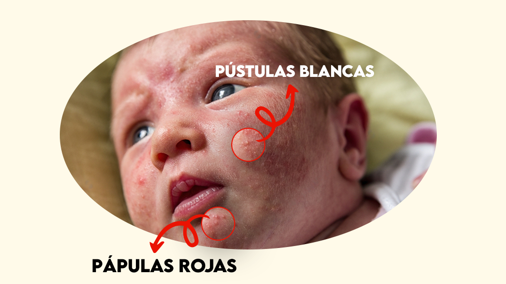 Pápulas rojas versus Pústulas blancas