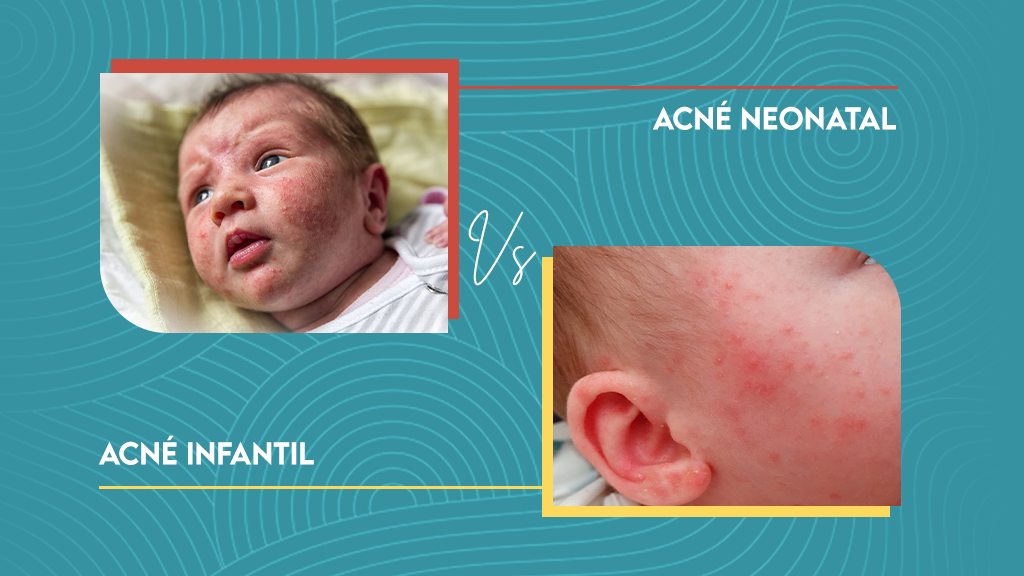 Acné neonatal versus acné infantil